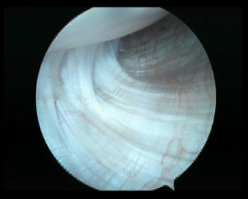 Arthroscopy Normal IGHL Humeral Insertion